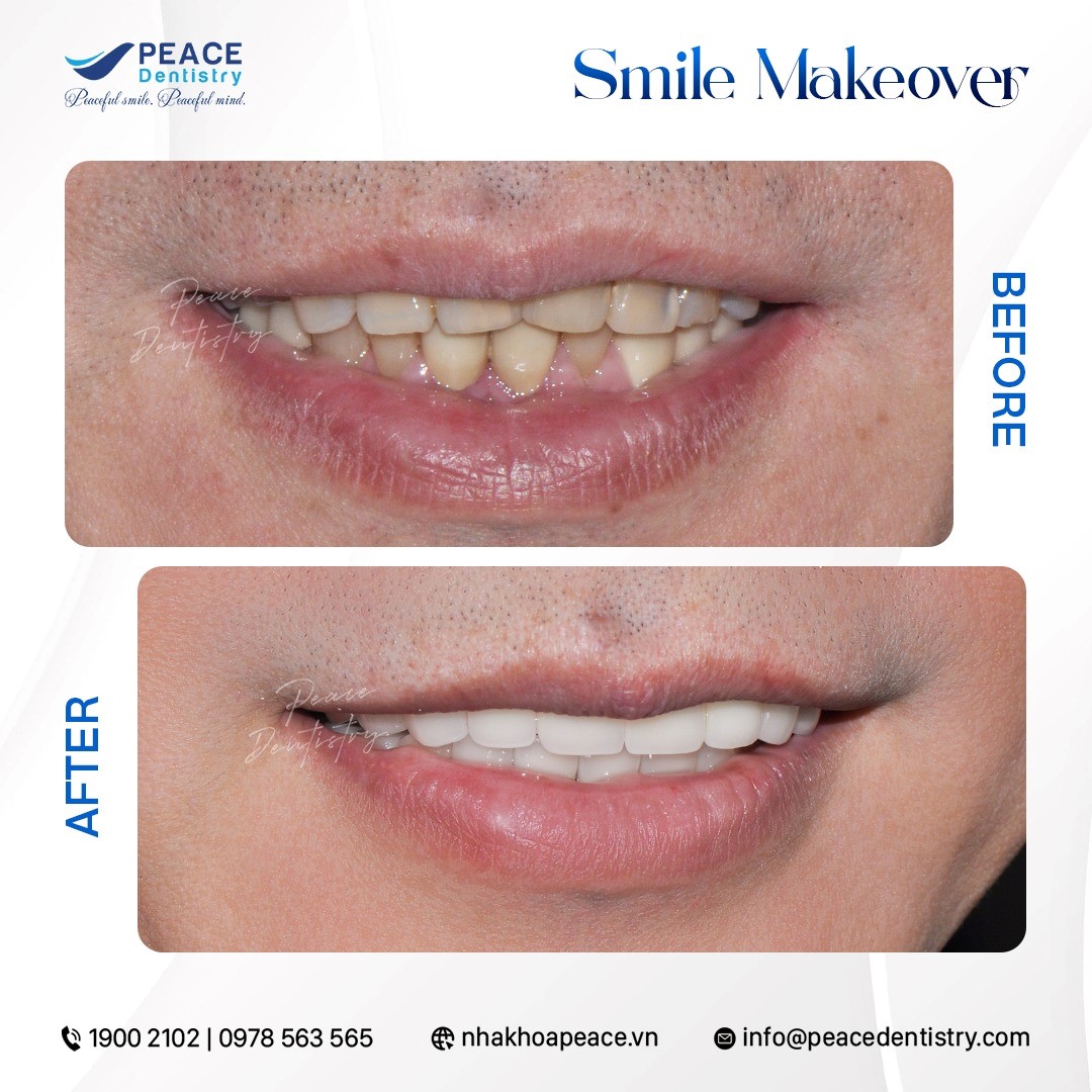 nên làm răng sứ hay niềng răng