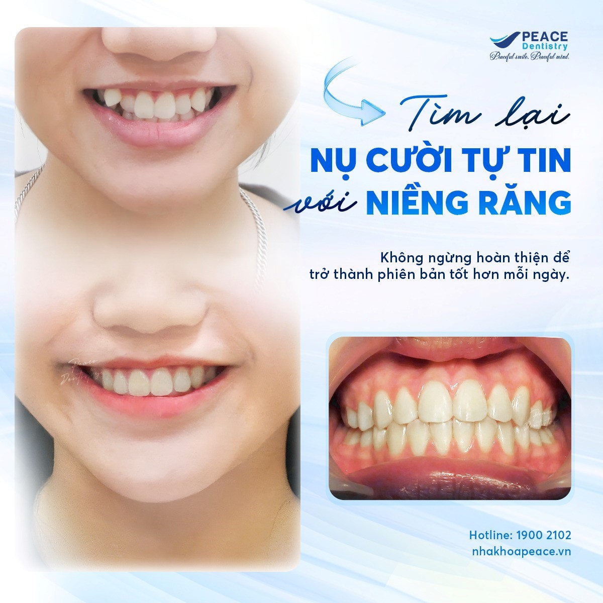 nên niềng răng hay bọc sứ