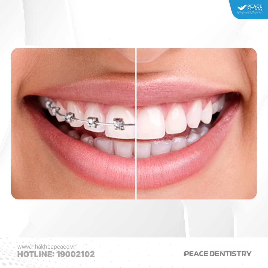 nên niềng răng hay làm răng sứ