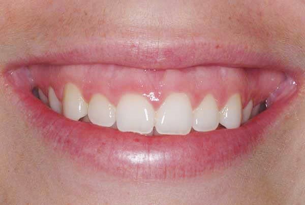 nguyên nhân gây ra cười hở lợi