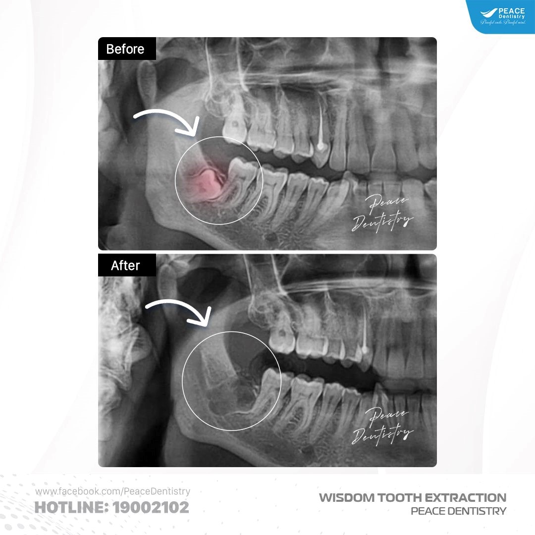 nhổ răng khôn mọc ngầm tại peace dentistry