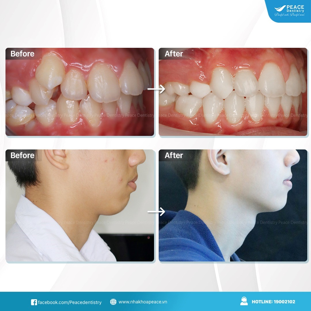 niềng răng chữa cười hở lợi