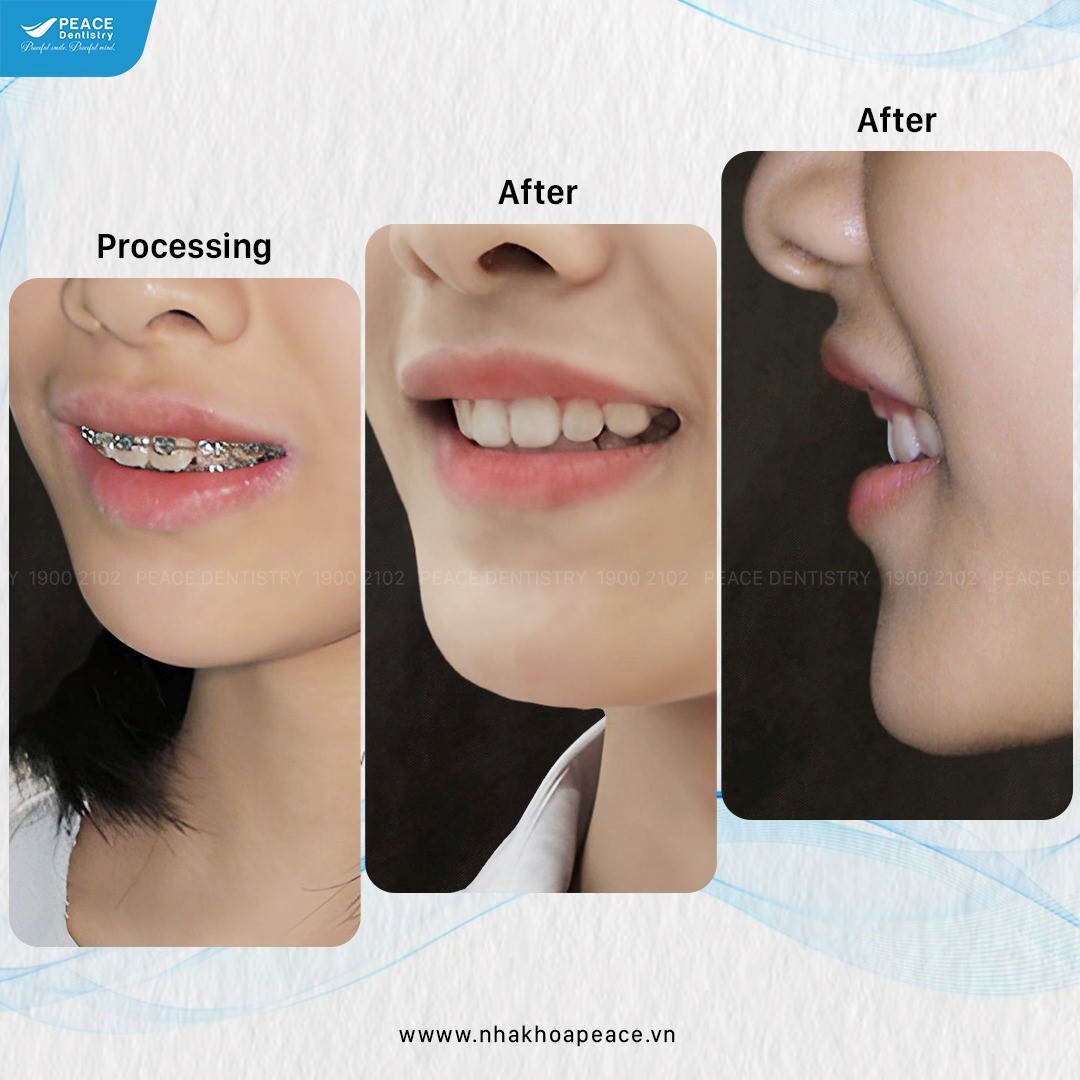 niềng răng có hết cười hở lợi không