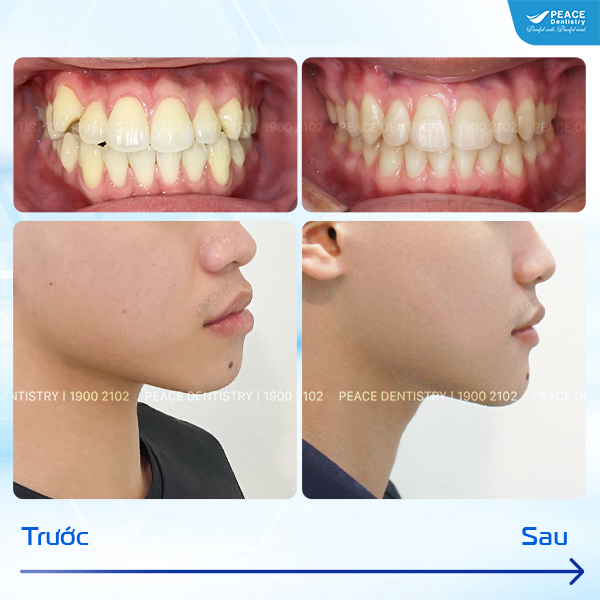 niềng răng giúp gương mặt hài hòa