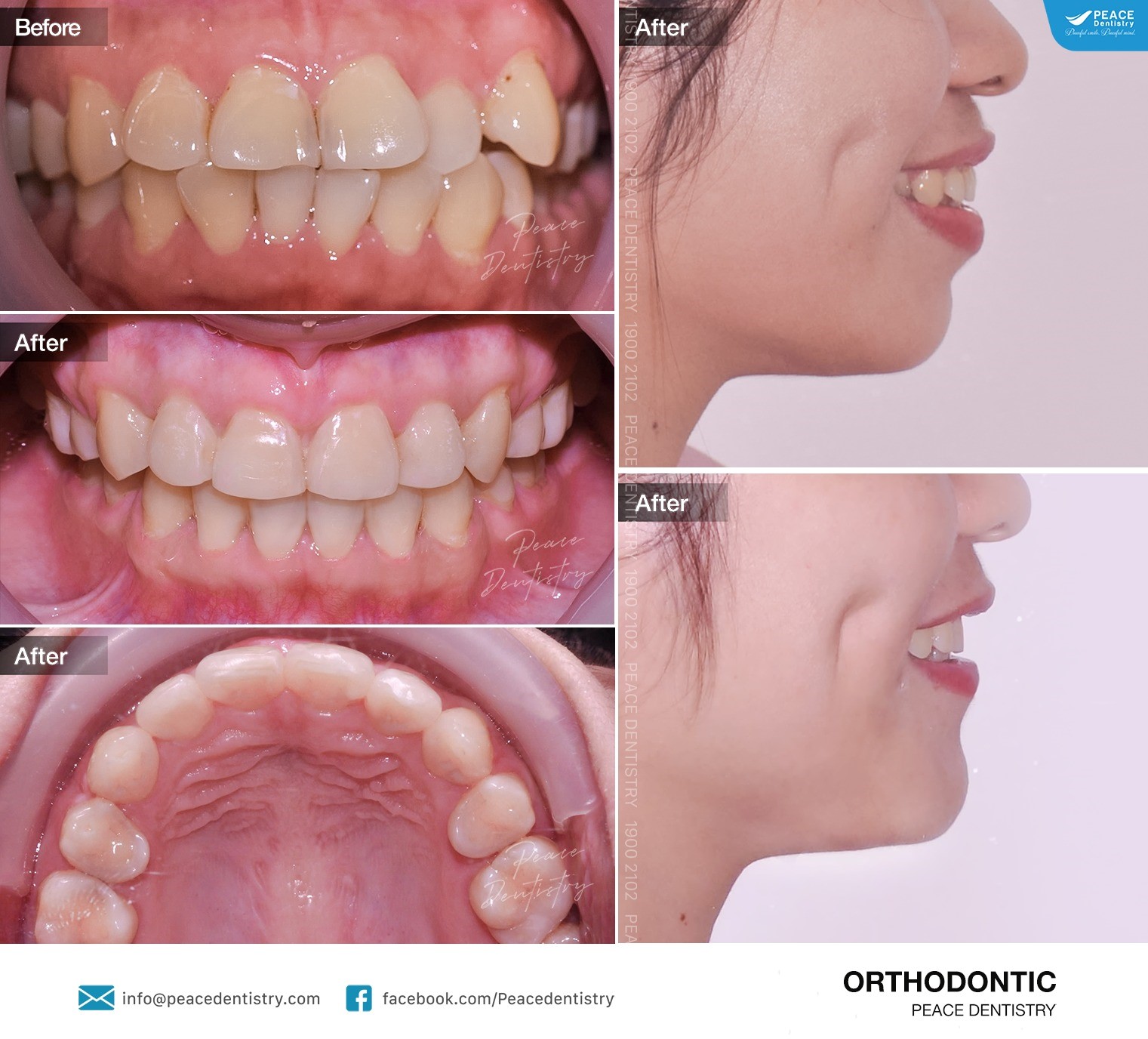 niềng răng hô hết bao nhiêu tiền