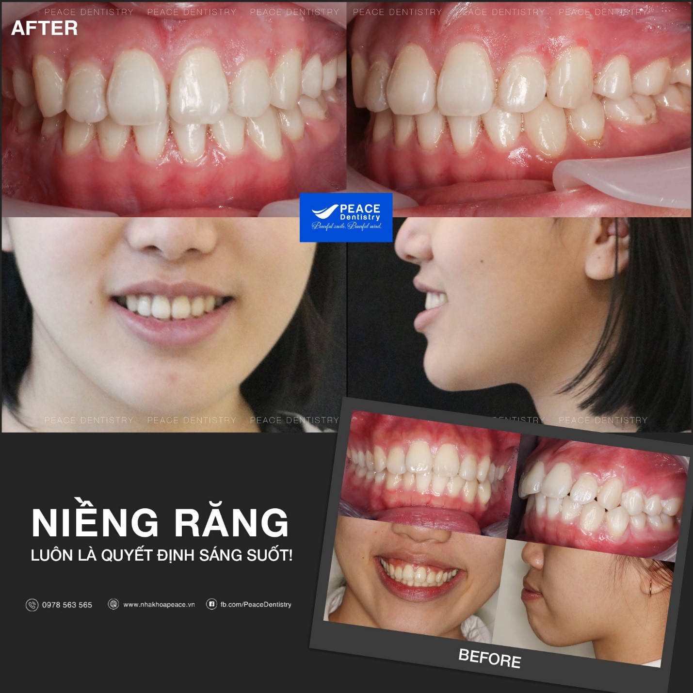 niềng răng hô mất bao lâu