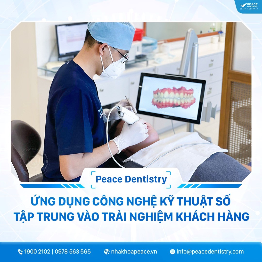 niềng răng hô mất bao nhiêu thời gian