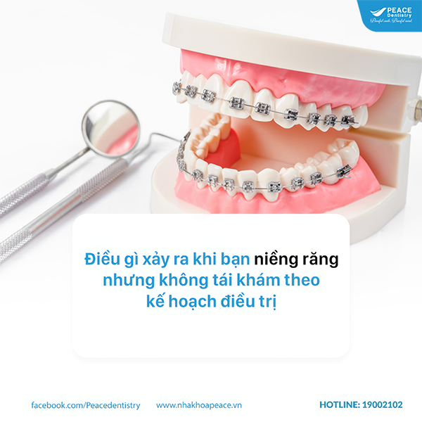 niềng răng không tái khám có sao không