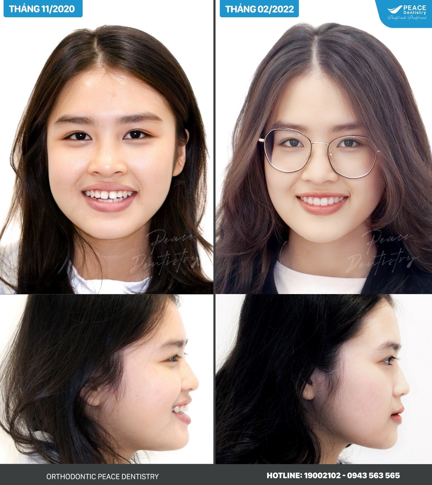 niềng răng móm giá bao nhiêu