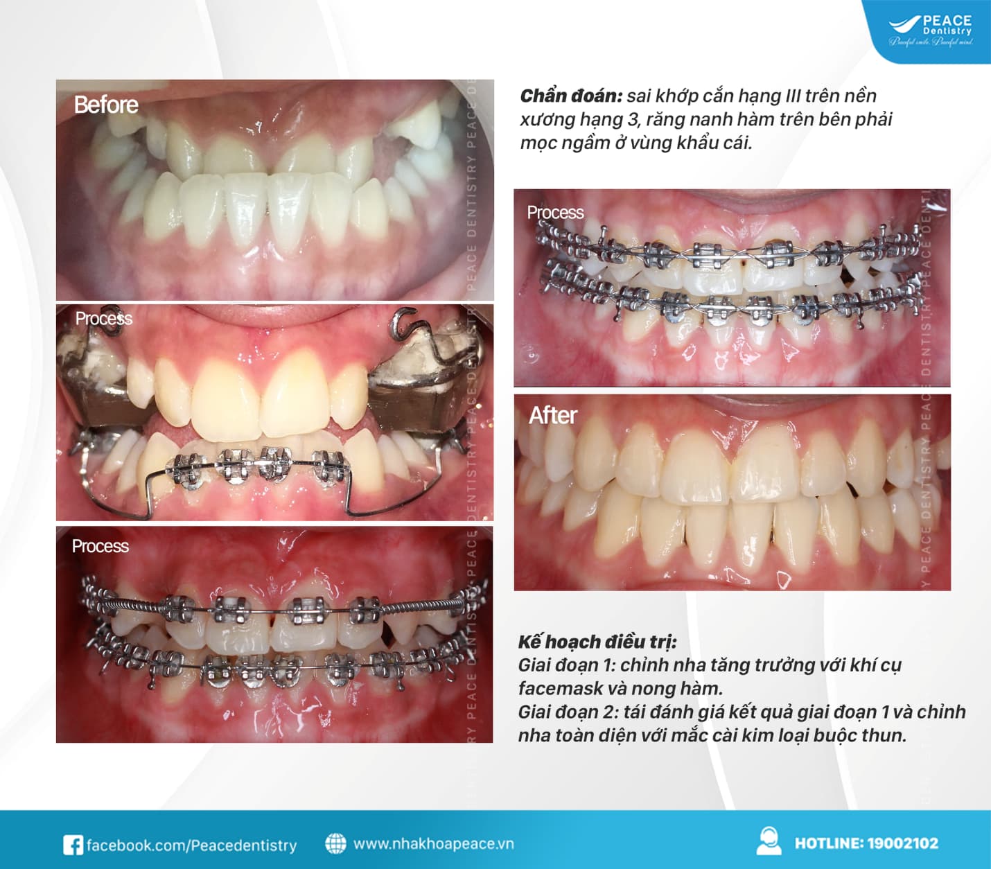 niềng răng móm hết bao nhiêu tiền
