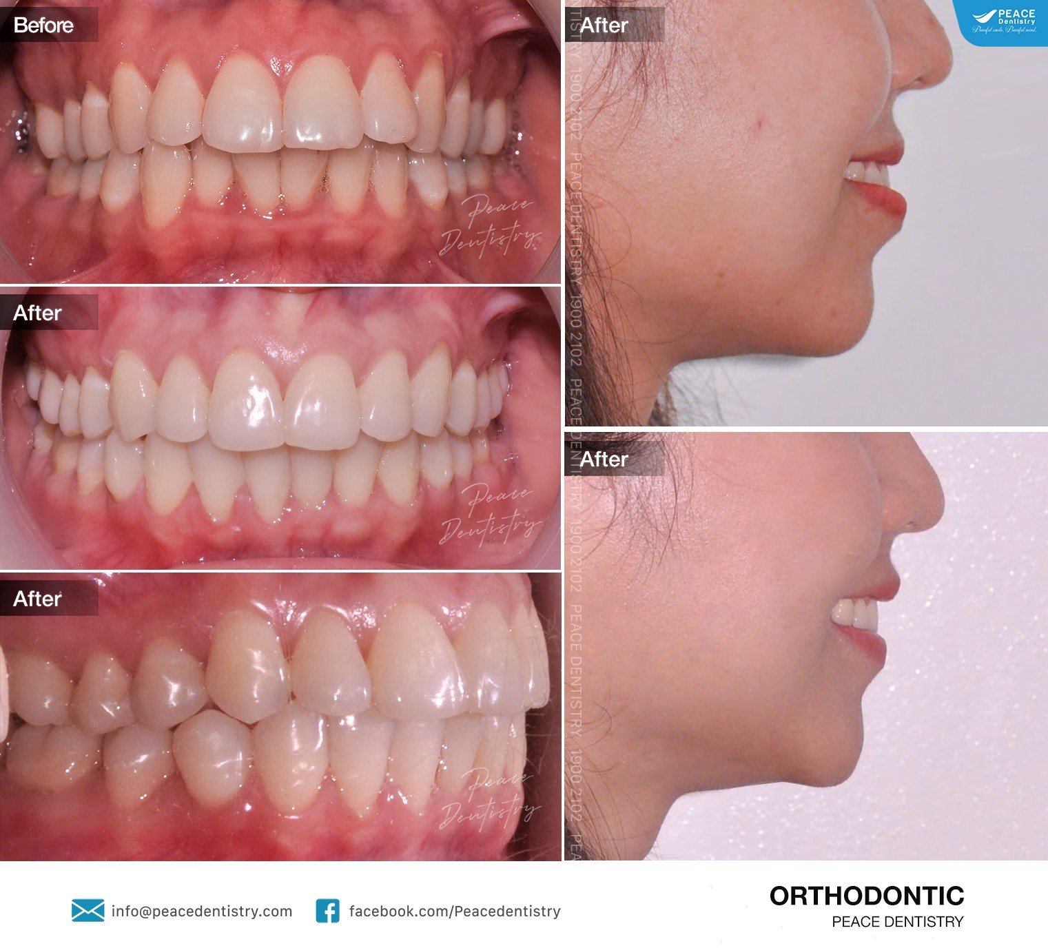 niềng răng trong suốt chữa cười hở lợi