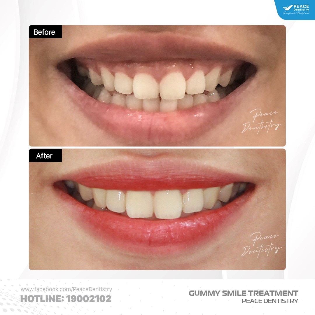 phẫu thuật cắt nướu chữa cười hở lợi