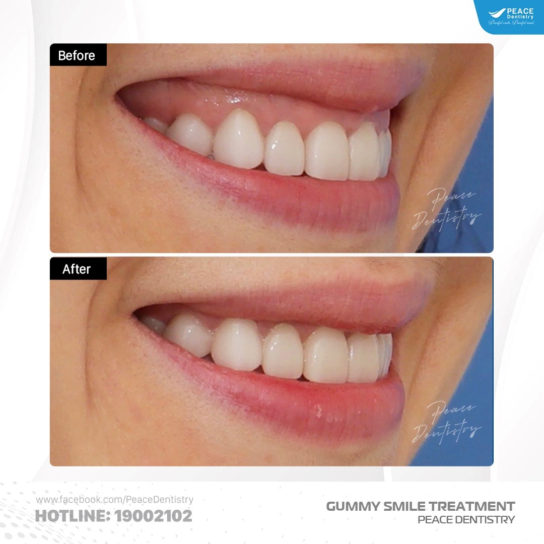 phẫu thuật cắt nướu