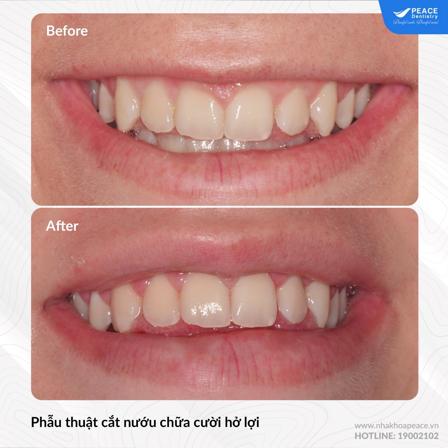 phẫu thuật cười hở lợi có đau không