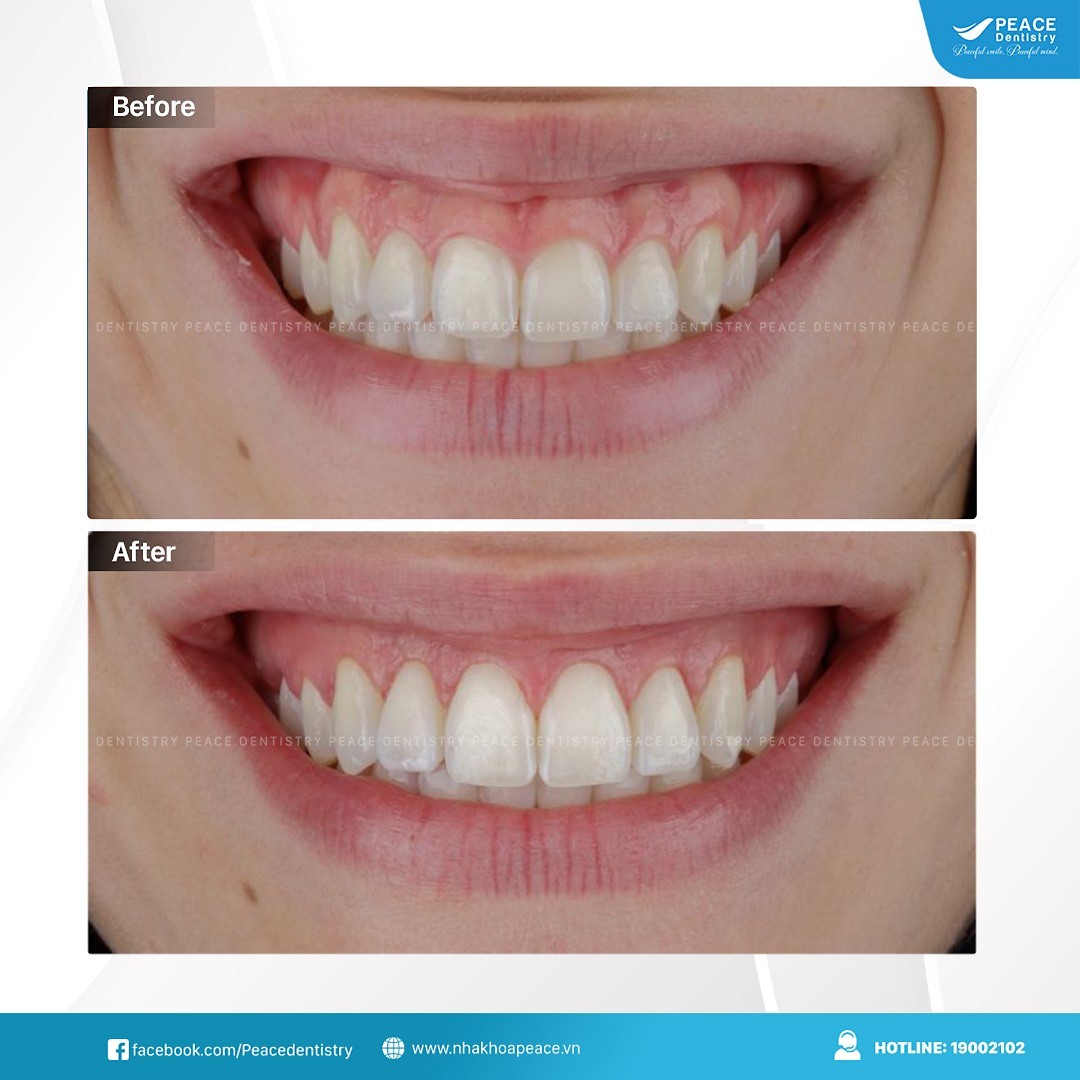 phẫu thuật hở lợi