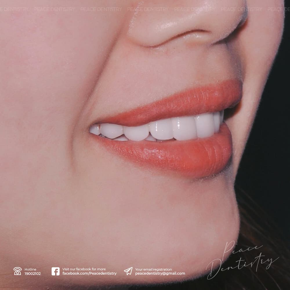 răng sứ có bị xuống màu không