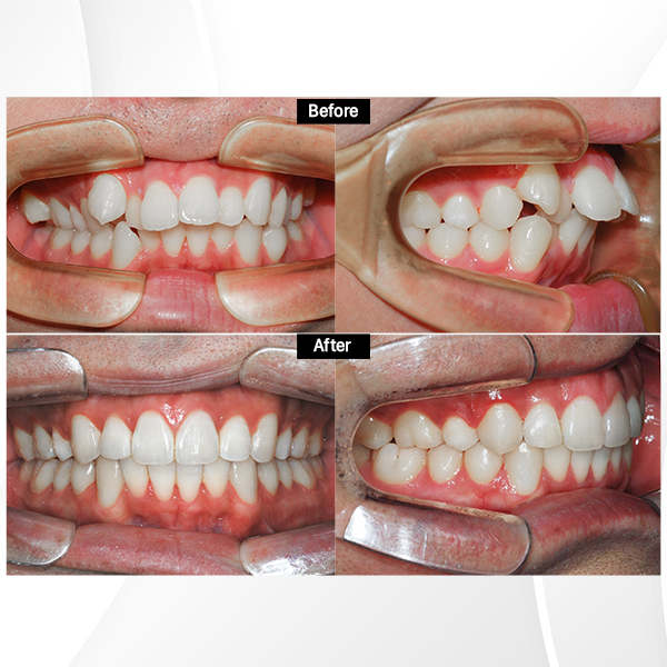 ca lâm sàng niềng răng invisalign