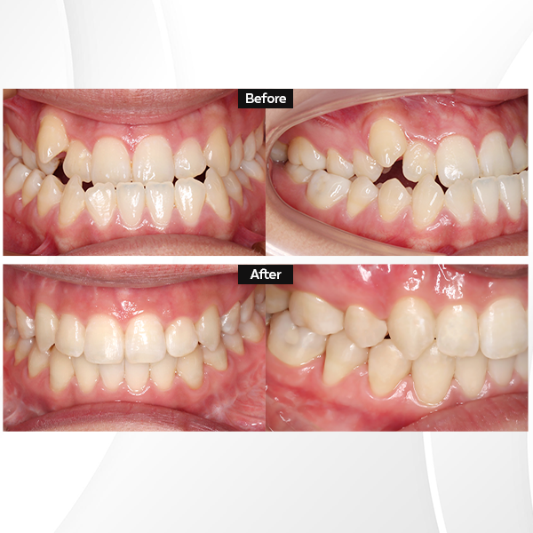 ca lâm sàng niềng răng invisalign