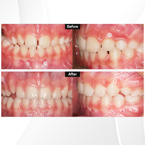 ca lâm sàng niềng răng invisalign