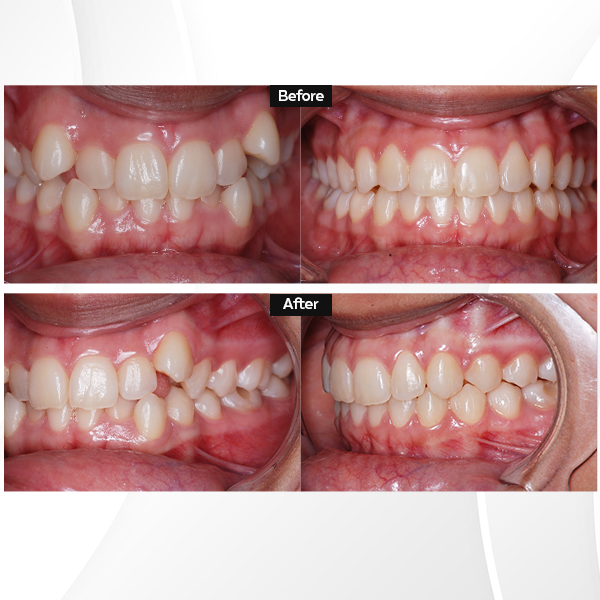 ca lâm sàng niềng răng invisalign