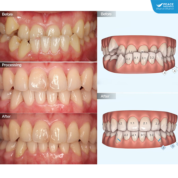 niềng răng invisalign cá nhân hóa điều trị