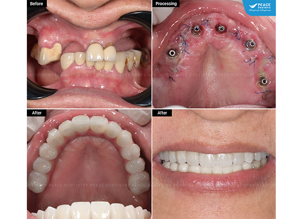 All-On-5 hàm trên, phục hình tức thì hàm BioHPP (không ghép xương), Cấy ghép 2 đơn vị Implant R44, R45 hàm dưới