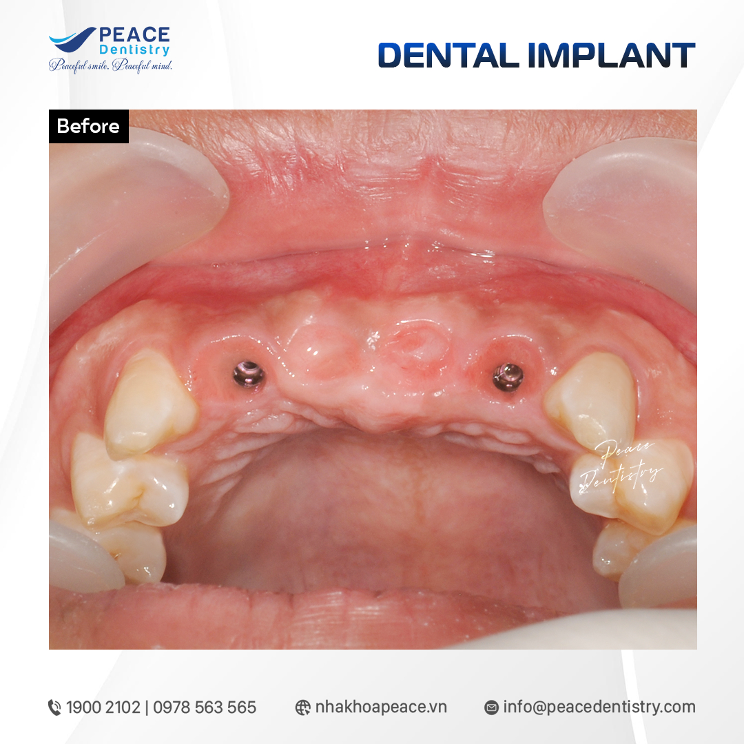 phục hồi răng cửa với cầu sứ trên implant