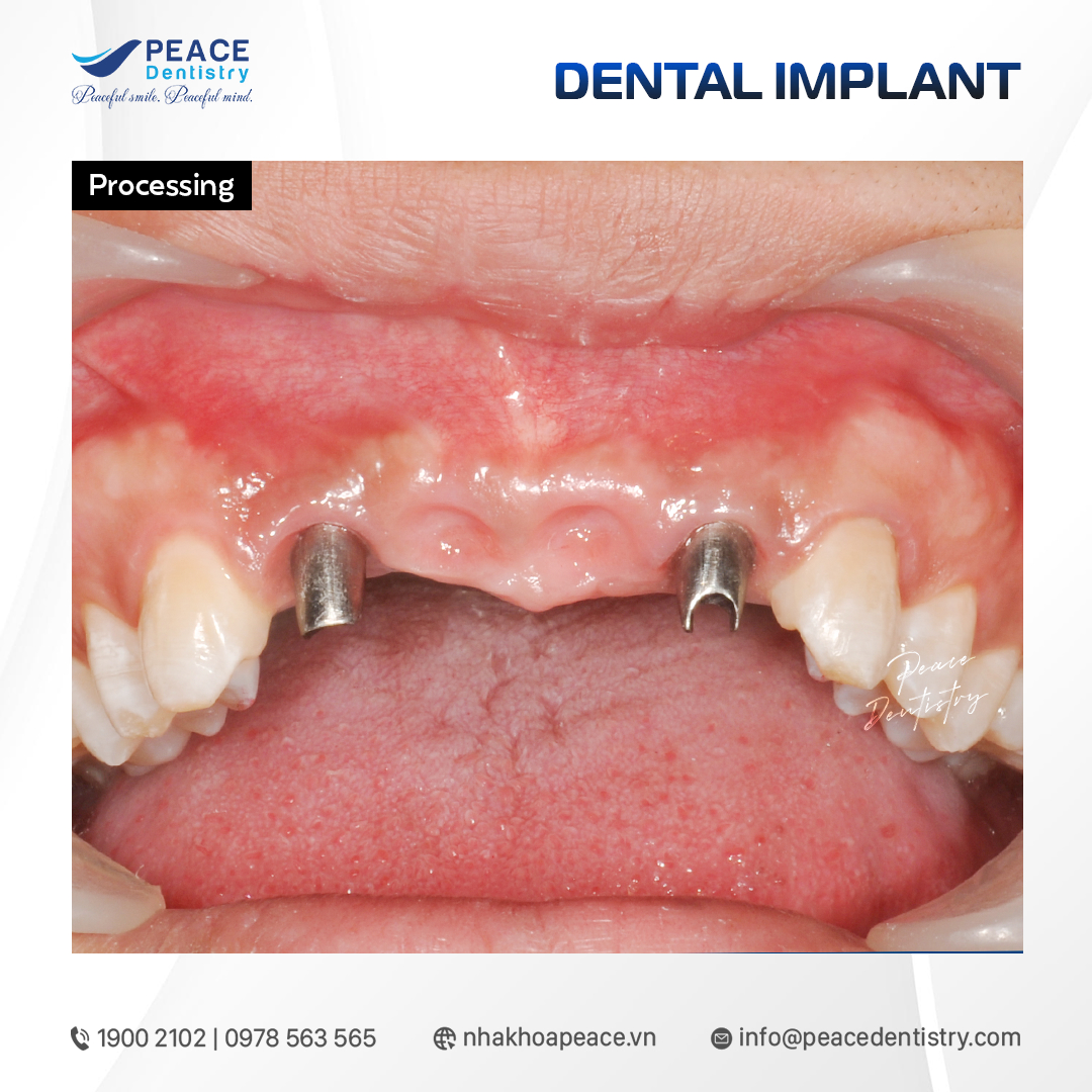 ca lâm sàng implant răng cửa