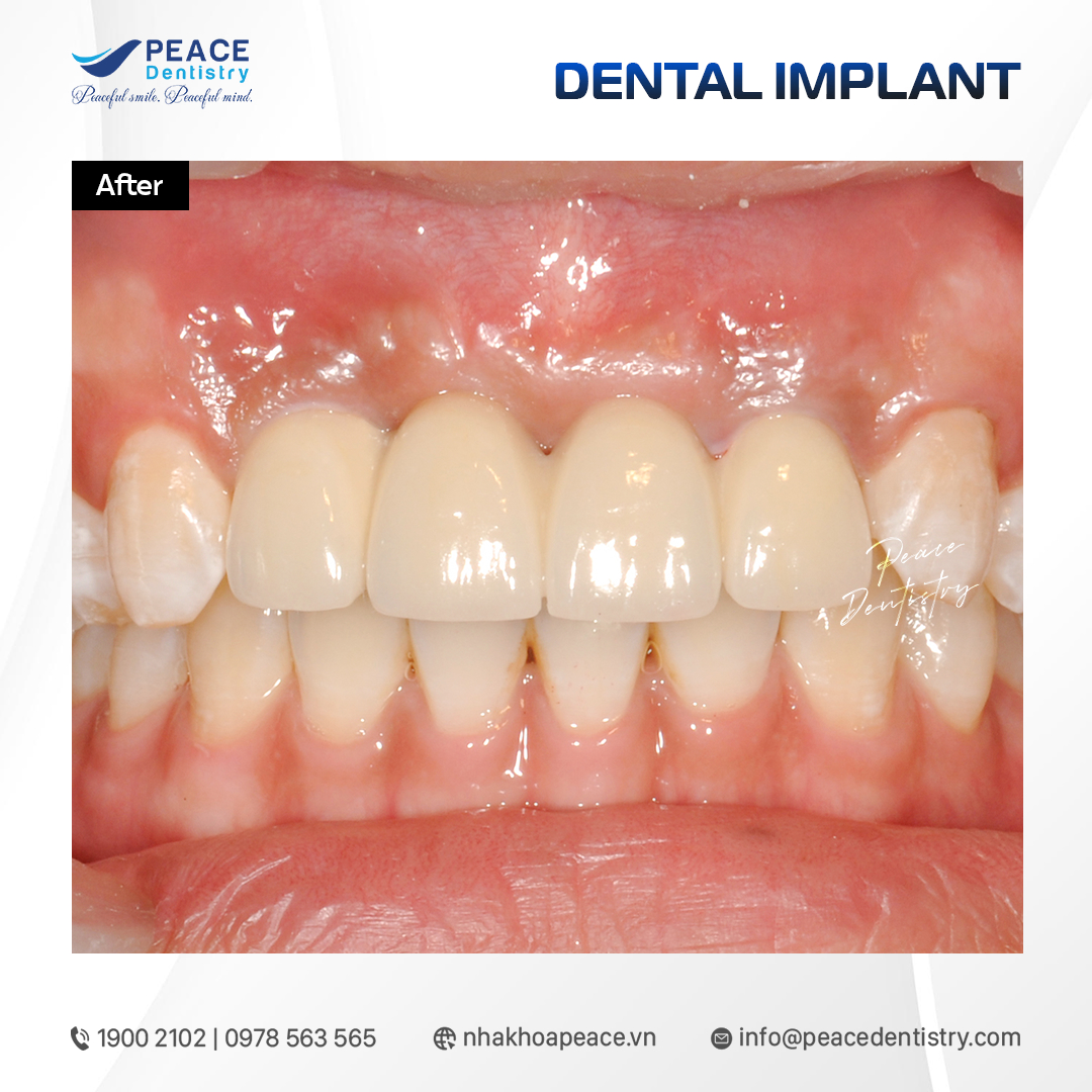 ca lâm sàng implant trên răng cửa