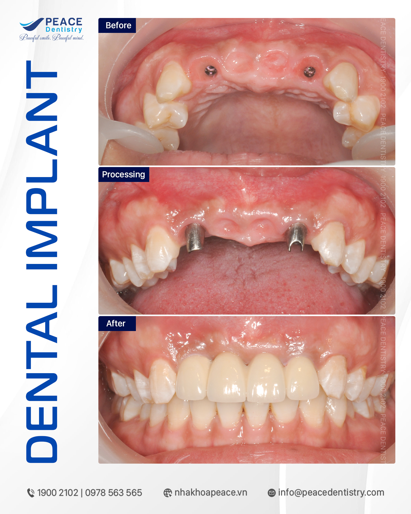 ca lâm sàng phục hình răng cửa trên implant