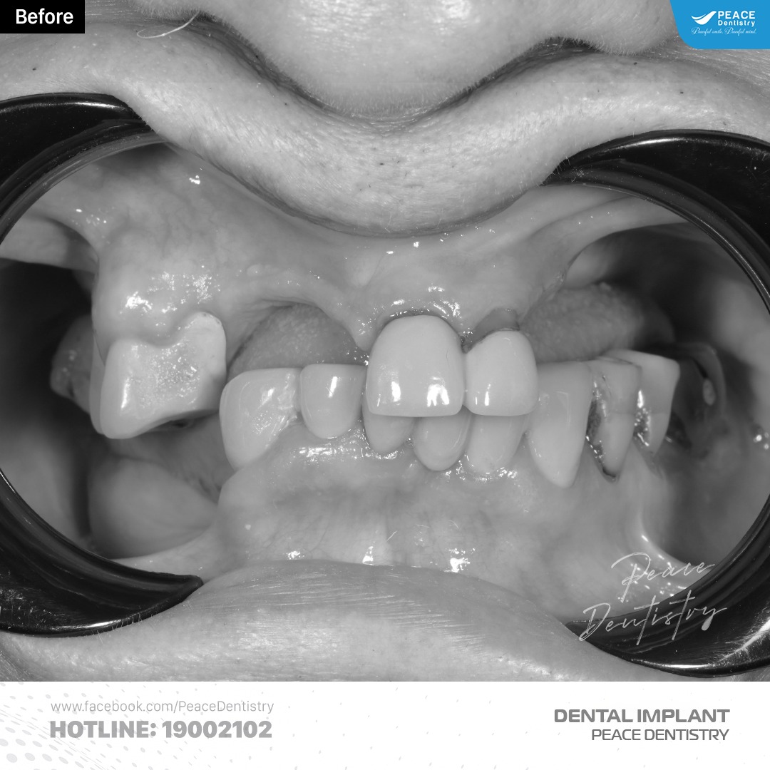 hình ảnh khách hàng trước khi trồng răng implant