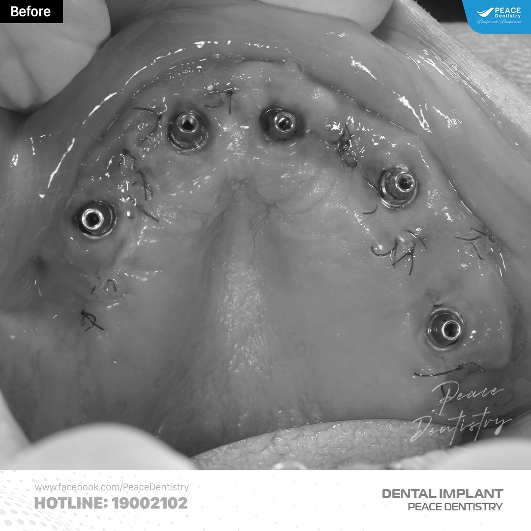 hình ảnh trồng răng implant all on 5 toàn hàm