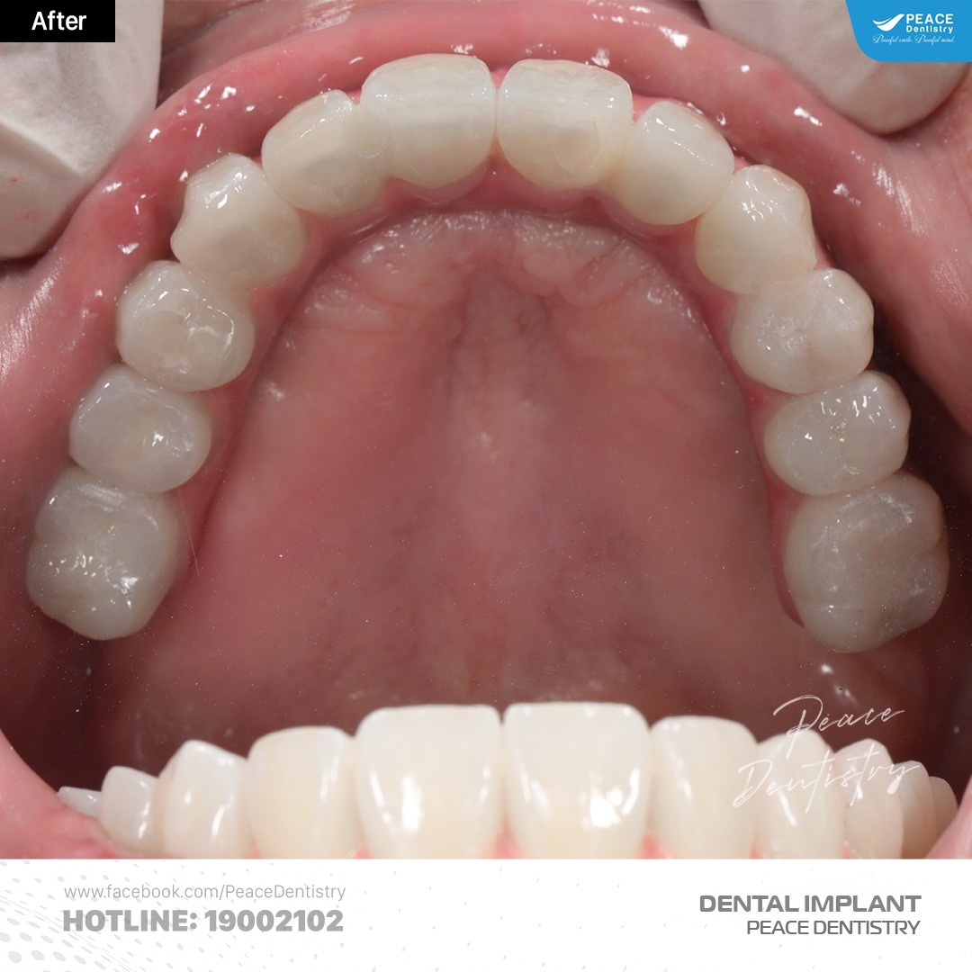 hình ảnh trồng răng implant all on 5 hàm trên