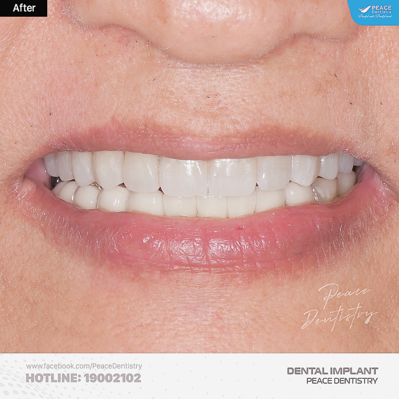 hình ảnh khách hàng sau khi trồng răng implant