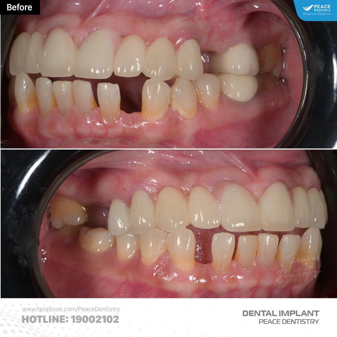 mất một số răng hàm nhai, tiêu xương nhiều