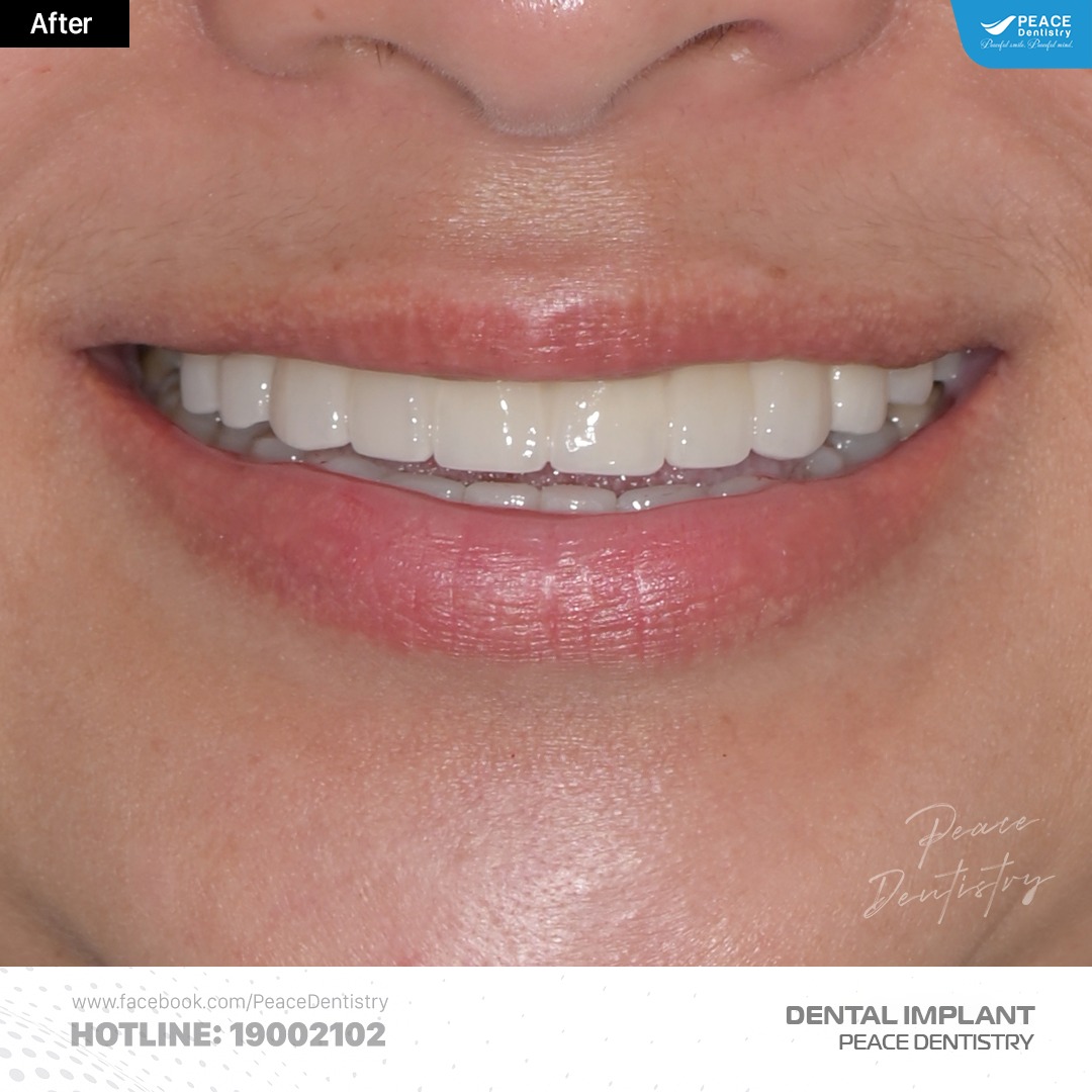 sau khi hoàn thành điều trị cấy ghép implant