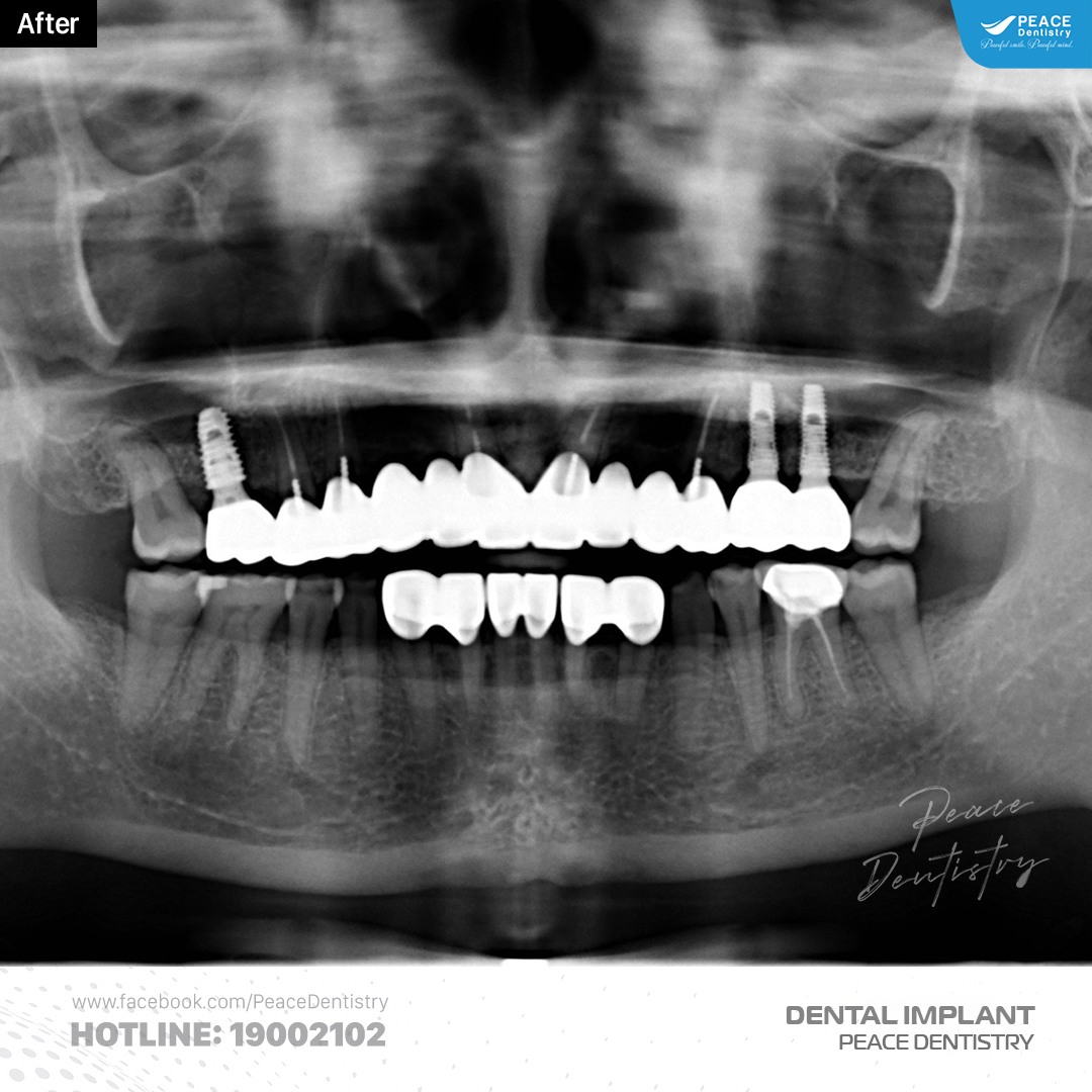 phim chụp panorex sau khi hoàn thành điều trị