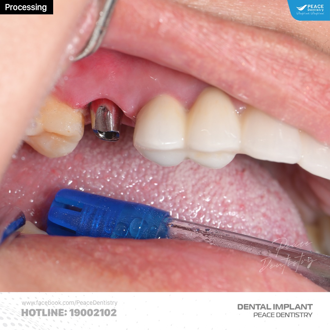 cấy ghép implant R16, nâng xoang kín, ghép xương GBR