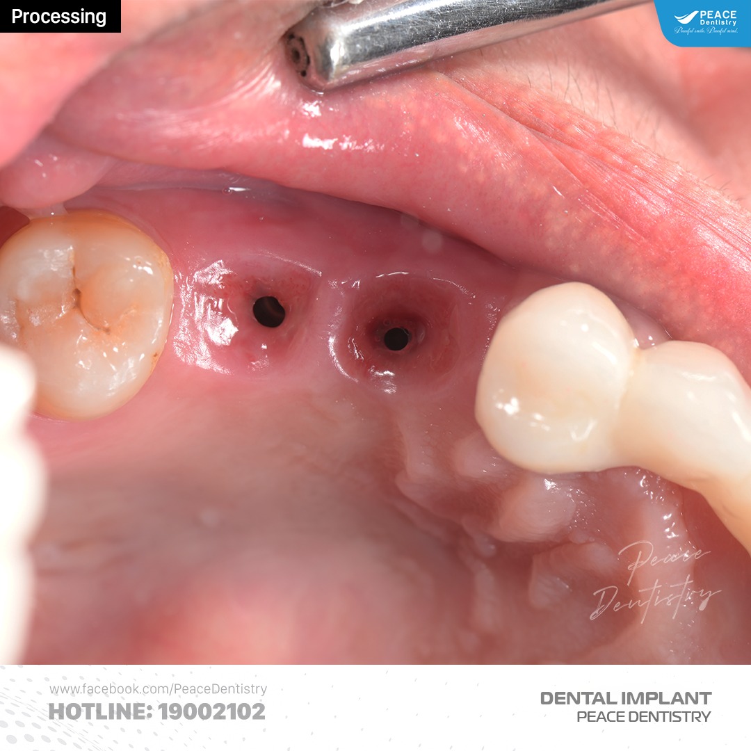 R25-26 sau khi tháo Healing để chuẩn bị phục hình trên implant