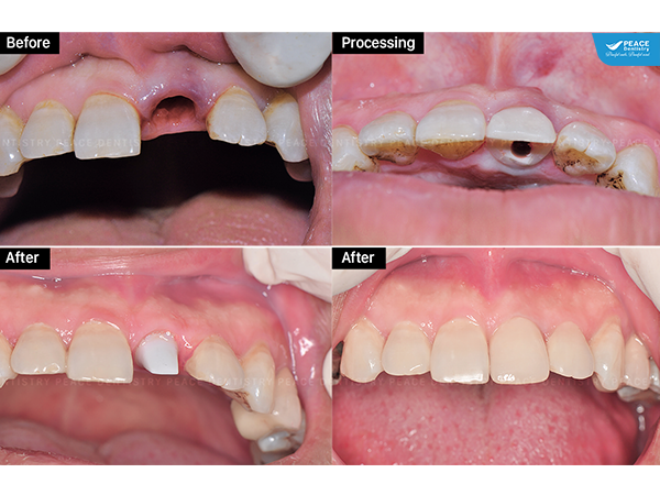 cắm trụ Implant Dentium Super Line tức thì và phục hình sứ Zirconia