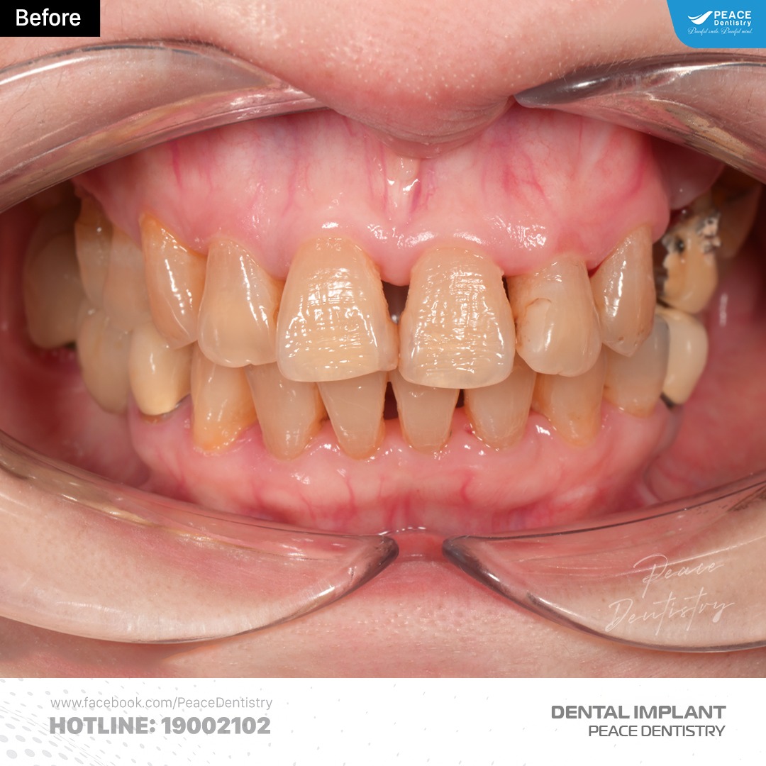 Ca lâm sàng cấy ghép implant và thẩm mỹ răng sứ 1