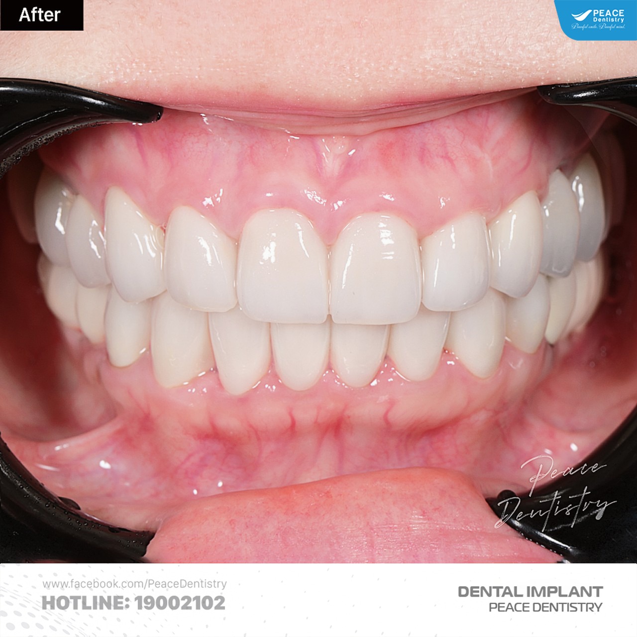 Ca lâm sàng cấy ghép implant và thẩm mỹ răng sứ 2