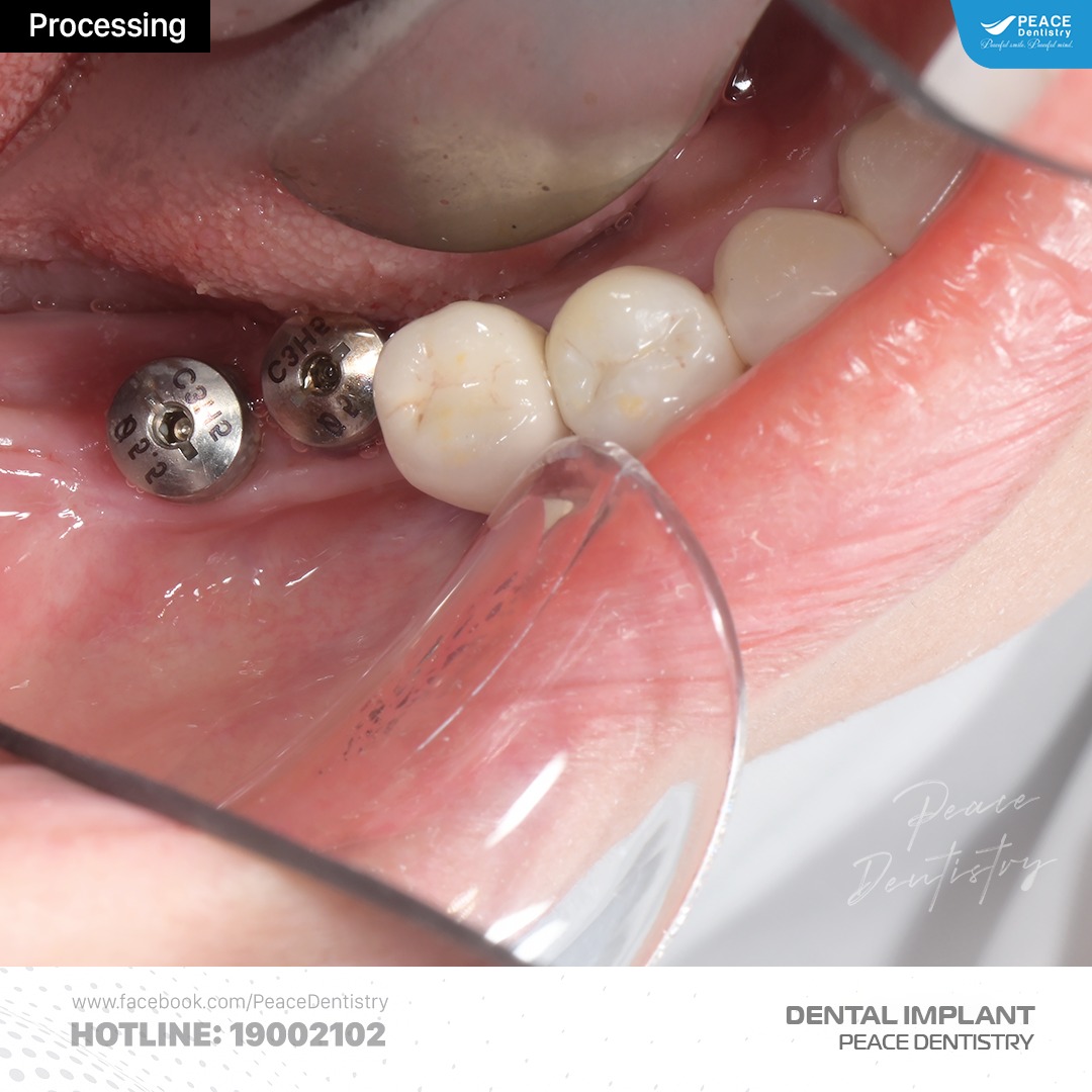 Ca lâm sàng cấy ghép implant và thẩm mỹ răng sứ 3