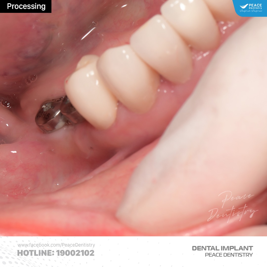 Ca lâm sàng cấy ghép implant và thẩm mỹ răng sứ 4