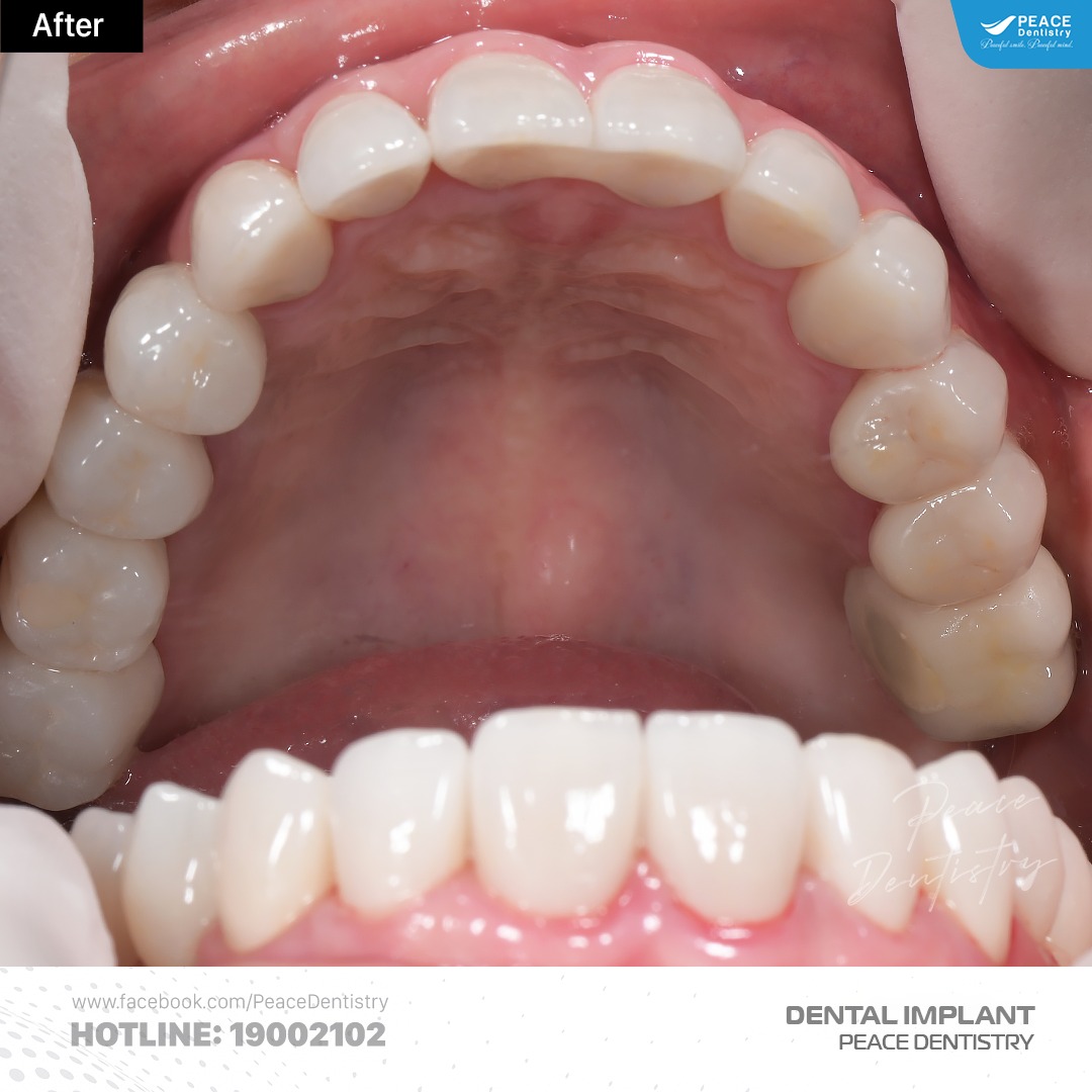 Ca lâm sàng cấy ghép implant và thẩm mỹ răng sứ 5