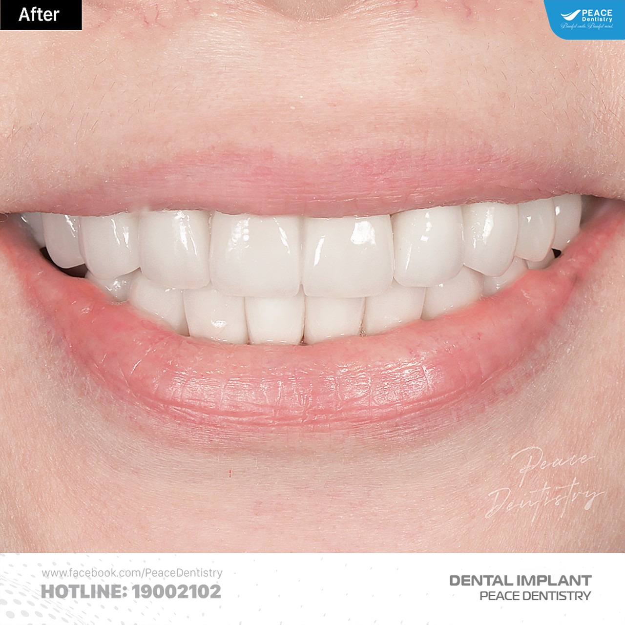 Ca lâm sàng cấy ghép implant và thẩm mỹ răng sứ 6