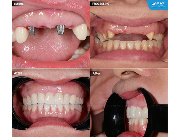 cấy 2 đơn vị implant để phục hồi 4 răng cửa đã mất nhiều năm