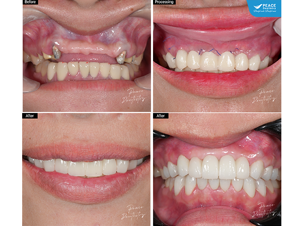 cấy ghép 2 đơn vị Implant thay thế cầu răng sứ dài cho khách hàng nữ mất 4 răng cửa nhiều năm