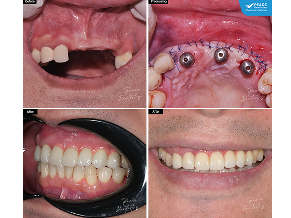 cấy ghép 3 trụ implant, phục hình FP3 giúp đường nướu đều đẹp