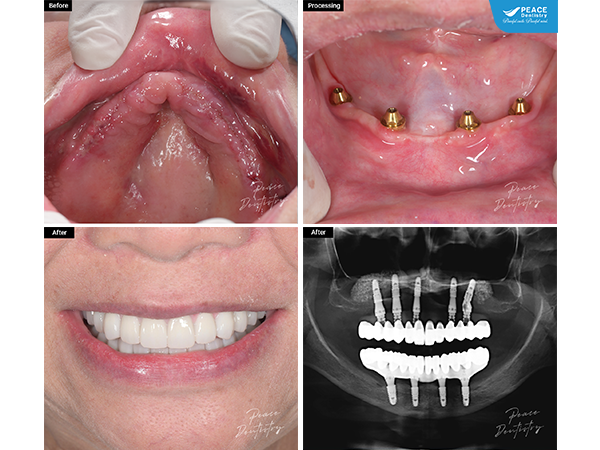 cấy ghép implant All-On-5 hàm trên & All-On-4 hàm dưới cho nữ khách hàng lớn tuổi đã mất hết răng